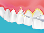 soins des gencives dentiste fecamp