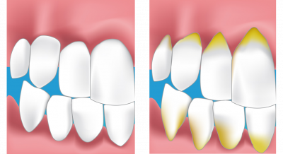 parodontie fecamp